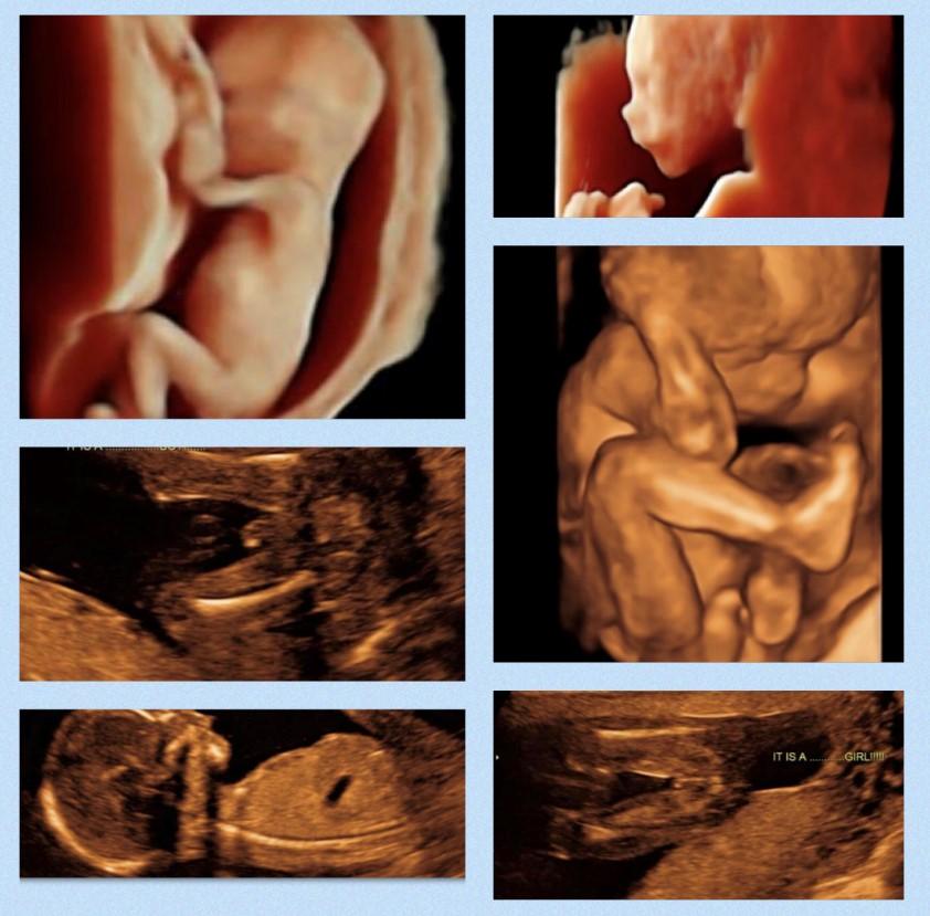 Well-being & Gender Scan | Baby i Love you Scan