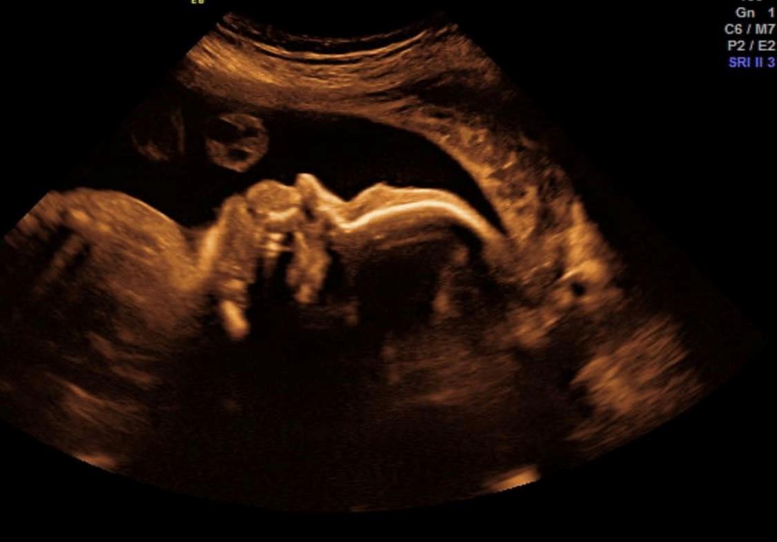 Growth Scan | Baby i Love you Scan